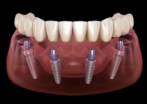 A graphic depicting All On 4 Dental Implants