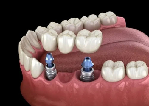 A graphic depicting a multiple tooth dental implant bridge