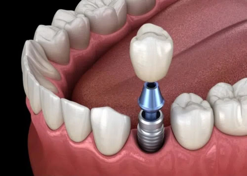 A graphic depicting a single tooth dental implant