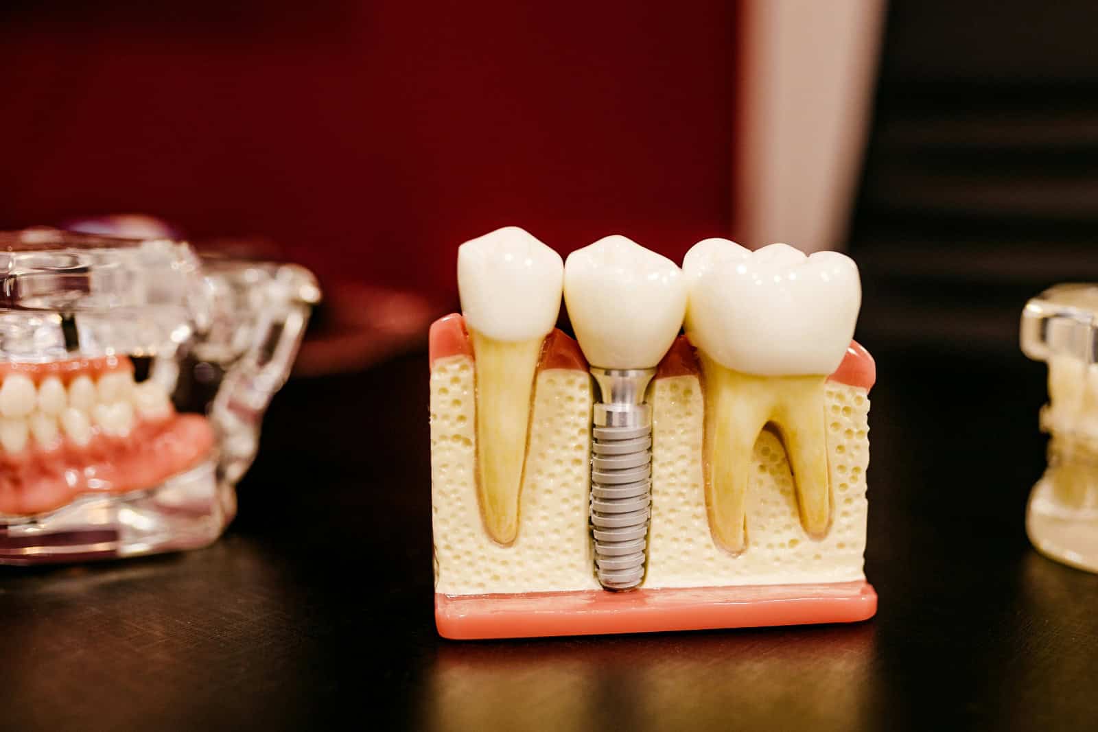 dental implants mockup on dentists desk, next to 2 dentures models