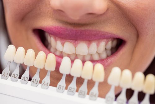 dentist matching veneers to woman's teeth