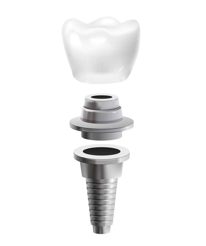 Diagram of a dental implant