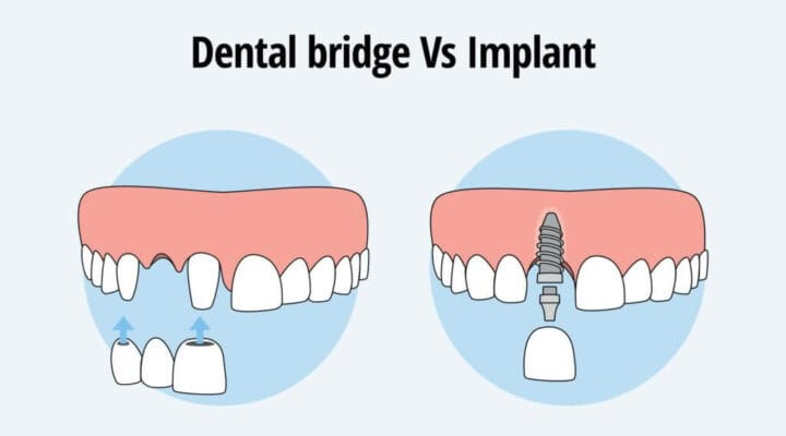 dental implant vs bridge