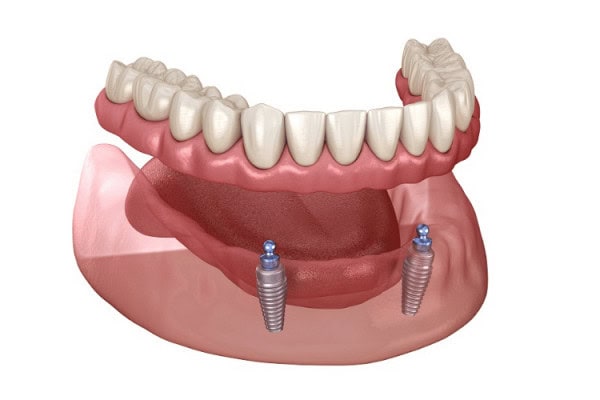 illustration of mini dental implants supporting dentures