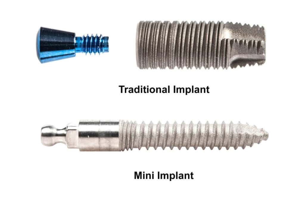 mini dental implant vs traditional dental implant (1)