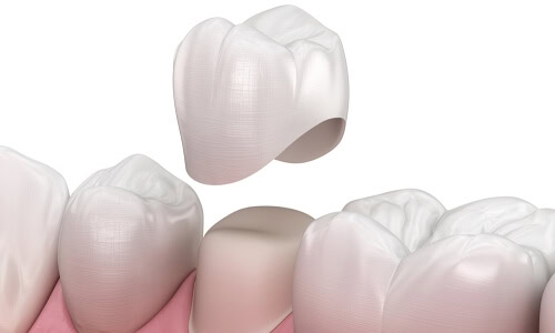 Dental Crown Diagram