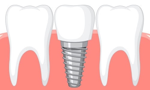 dental implants diagram (1)
