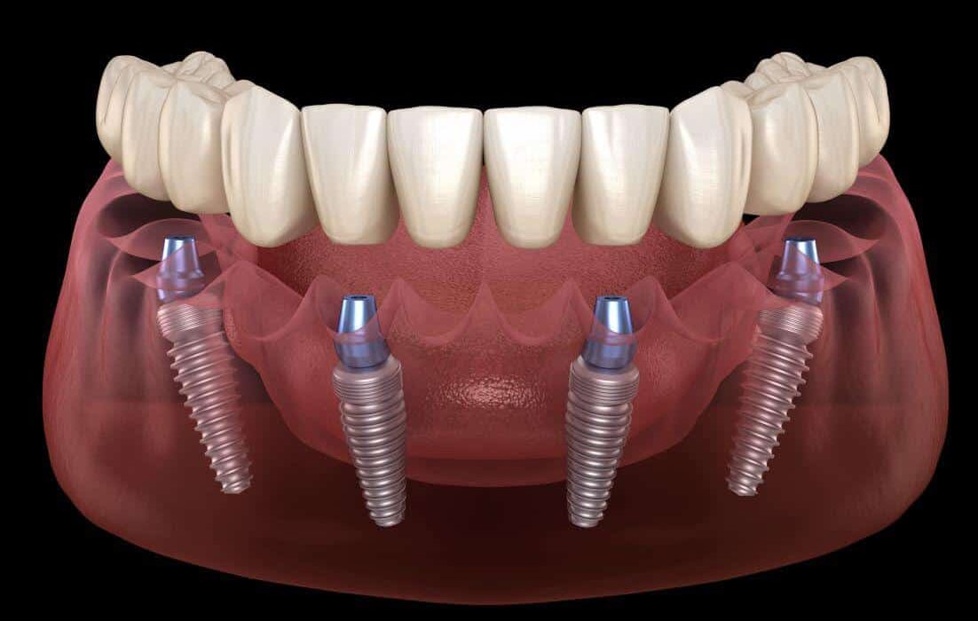 full arch dental implant illustration