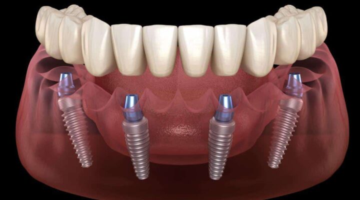 full arch dental implant illustration