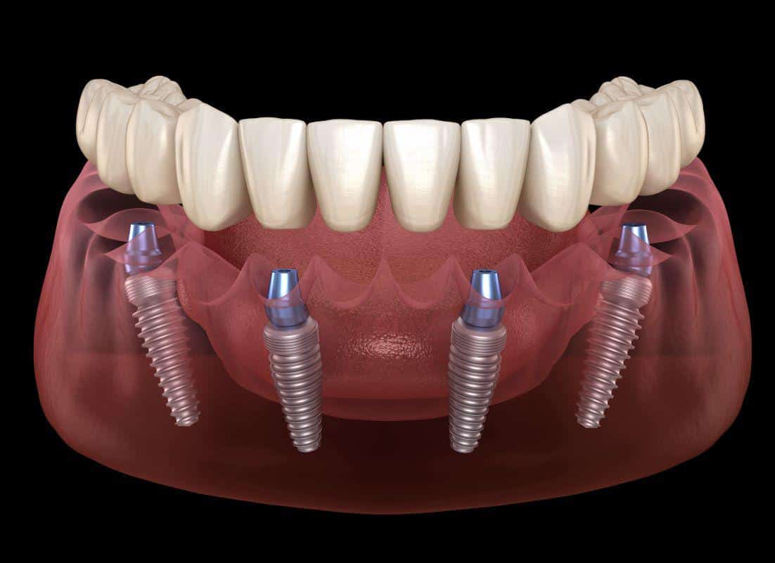 full arch dental implant illustration