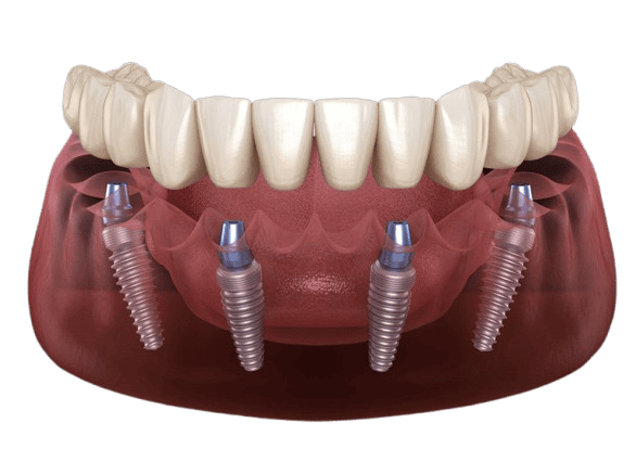 all on 4 dental implants