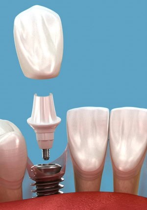 dental implant illustration showing components