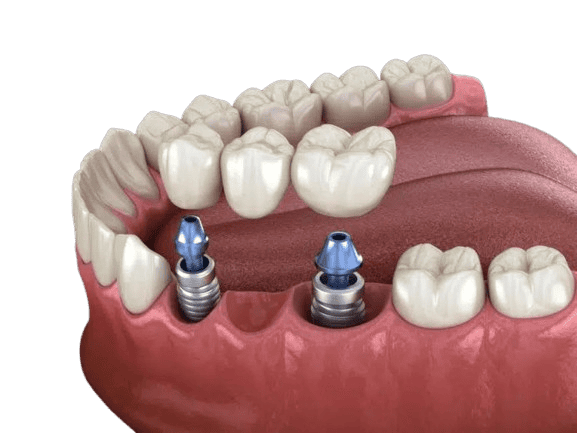dental implant supported bridge