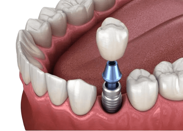 dental implant supported tooth crown