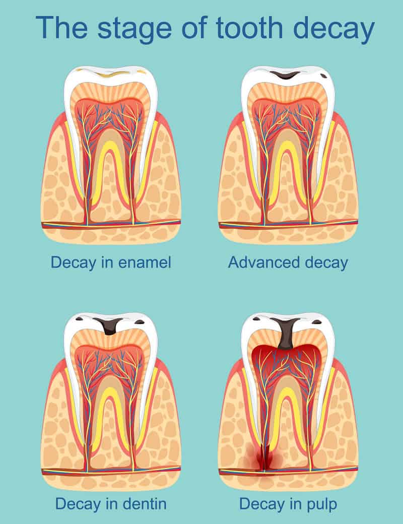 stages of tooth decay infographic