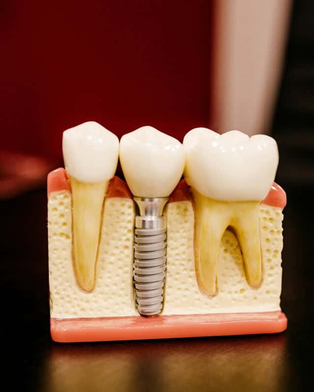 dental implants mockup on dentists desk 800x640