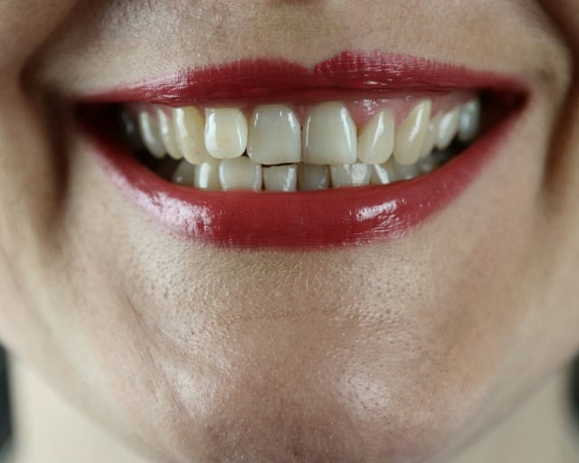 Closeup of middle-aged woman smiling with imperfect teeth